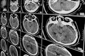 xray of brain injury